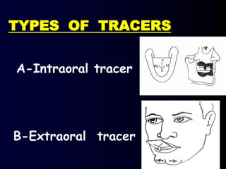 TYPES OF TRACERS
A-Intraoral tracer
B-Extraoral tracer
 