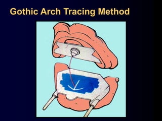 Gothic Arch Tracing Method
 