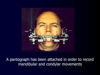 A pantograph has been attached in order to record
mandibular and condylar movements
 