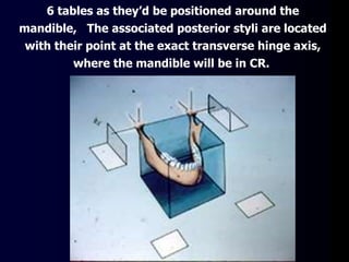 6 tables as they’d be positioned around the
mandible, The associated posterior styli are located
with their point at the exact transverse hinge axis,
where the mandible will be in CR.
 