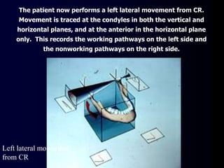 Left lateral movement
from CR
The patient now performs a left lateral movement from CR.
Movement is traced at the condyles in both the vertical and
horizontal planes, and at the anterior in the horizontal plane
only. This records the working pathways on the left side and
the nonworking pathways on the right side.
 