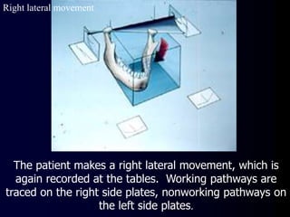Right lateral movement
The patient makes a right lateral movement, which is
again recorded at the tables. Working pathways are
traced on the right side plates, nonworking pathways on
the left side plates.
 