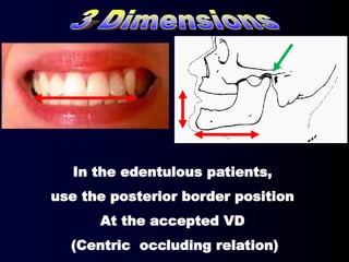 In the edentulous patients,
use the posterior border position
At the accepted VD
(Centric occluding relation)
 