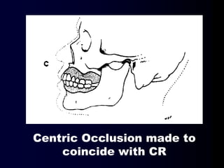Centric Occlusion made to
coincide with CR
 