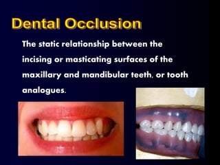 The static relationship between the
incising or masticating surfaces of the
maxillary and mandibular teeth, or tooth
analogues.
 