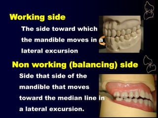 Working side
Non working (balancing) side
Side that side of the
mandible that moves
toward the median line in
a lateral excursion.
The side toward which
the mandible moves in a
lateral excursion
 