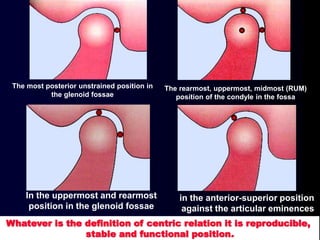Whatever is the definition of centric relation it is reproducible,
stable and functional position.
The rearmost, uppermost, midmost (RUM)
position of the condyle in the fossa
The most posterior unstrained position in
the glenoid fossae
In the uppermost and rearmost
position in the glenoid fossae
in the anterior-superior position
against the articular eminences
 