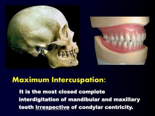 Maximum Intercuspation:
It is the most closed complete
interdigitation of mandibular and maxillary
teeth irrespective of condylar centricity.
 
