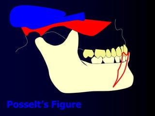 Posselt’s Figure
 