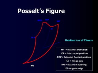 MP
MO
ICPRCP
H A
MP = Maximal protrusion
ICP = Intercuspal position
RCP= Retruded Contact position
HA = Hinge axis
MO = Maximum opening
EE=edge to edge
Posselt’s Figure
Habitual Arc of Closure
EE
 