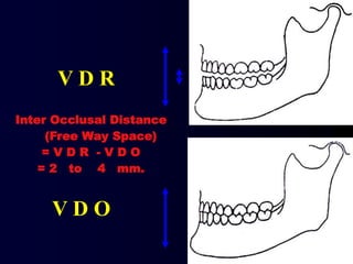 V D R
V D O
Inter Occlusal Distance
(Free Way Space)
= V D R - V D O
= 2 to 4 mm.
 