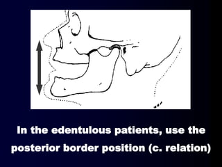 In the edentulous patients, use the
posterior border position (c. relation)
 