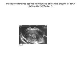 implantasyon tarafında desidual kalınlaşma ile birlikte fokal ekojenik bir zonun görülmesidir [14](Resim- 2). 