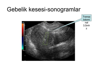 Gebelik kesesi-sonogramlar Transabdominal 3.5mhz 