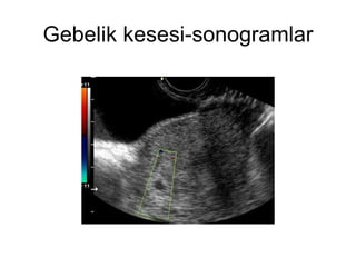 Gebelik kesesi-sonogramlar 