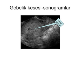 Gebelik kesesi-sonogramlar transvag,inal 6.5 