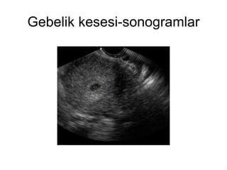 Gebelik kesesi-sonogramlar 
