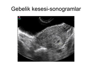 Gebelik kesesi-sonogramlar 
