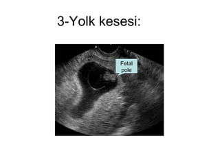 3-Yolk kesesi: Fetal pole 