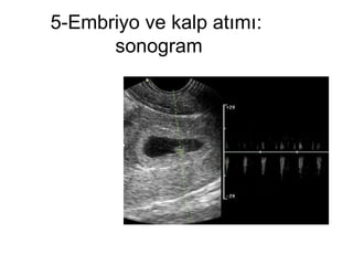 5-Embriyo ve kalp atımı:  sonogram 