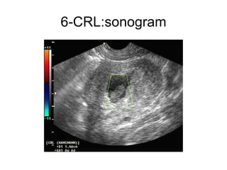 6-CRL:sonogram 