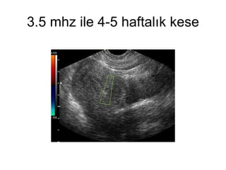 3.5 mhz ile 4-5 haftalık kese 