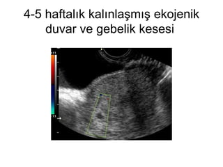 4-5 haftalık kalınlaşmış ekojenik duvar ve gebelik kesesi  