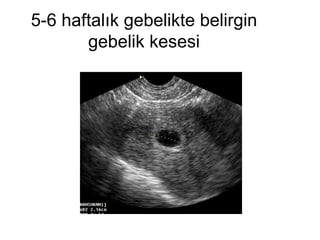5-6 haftalık gebelikte belirgin gebelik kesesi 