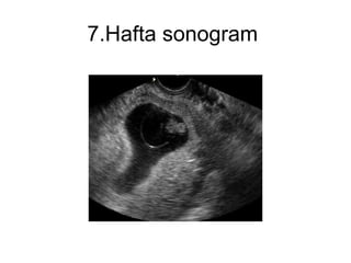 7.Hafta sonogram  