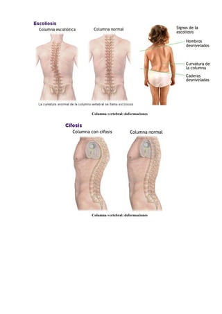 Columna vertebral: deformaciones




Columna vertebral: deformaciones
 