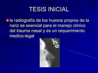 TESIS INICIAL<br />la radiografía de los huesos propios de la nariz es esencial para el manejo clínico del trauma nasal y ...