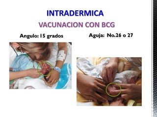 VACUNACION CON BCG
INTRADERMICA
Angulo: 15 grados Aguja: No.26 o 27
 