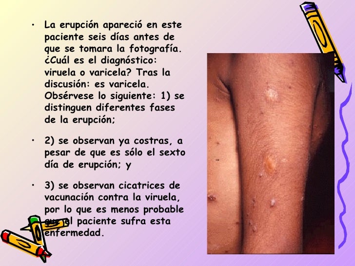 1. varila , viruela y sarampion