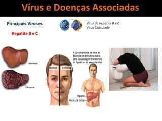 Vírus e Doenças Associadas
Principais Viroses
Hepatite B e C
Vírus da hepatite B e C
Vírus Capsulado
 