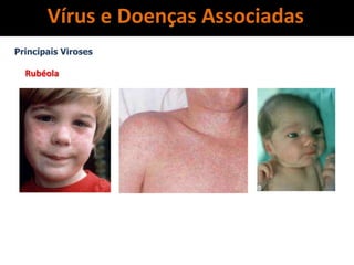 Vírus e Doenças Associadas
Principais Viroses
Rubéola
 