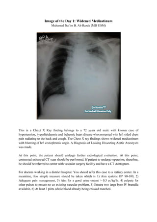 Image of the Day 1: Widened Mediastinum
                          Muhamad Na’im B. Ab Razak (MD USM)




This is a Chext X Ray finding belongs to a 72 years old male with known case of
hypertension, hyperlipidaemia and Ischemic heart disease who presented with left sided chest
pain radiating to the back and cough. The Chest X ray findings shows widened mediastinum
with blunting of left costophrenic angle. A Diagnosis of Leaking Dissecting Aortic Aneurysm
was made.

At this point, the patient should undergo further radiological evaluation. At this point,
contrasted enhanced CT scan should be performed. If patient to undergo operation, therefore,
he should be referred to center with vascular surgery facility and have a CT Aortogram.

For doctors working in a district hospital. You should refer this case to a tertiary center. In a
meantime, few simple measure should be taken which is 1) Aim systolic BP 90-100, 2)
Adequate pain management, 3) Aim for a good urine output > 0.5 cc/kg/hr, 4) palpate for
other pulses to ensure no co existing vascular problem, 5) Ensure two large bore IV branulla
available, 6) At least 3 pints whole blood already being crossed matched.
 