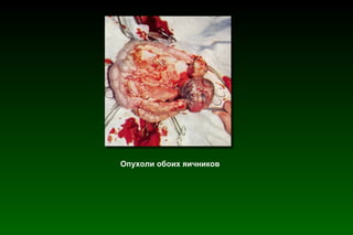 Опухоли обоих яичников 