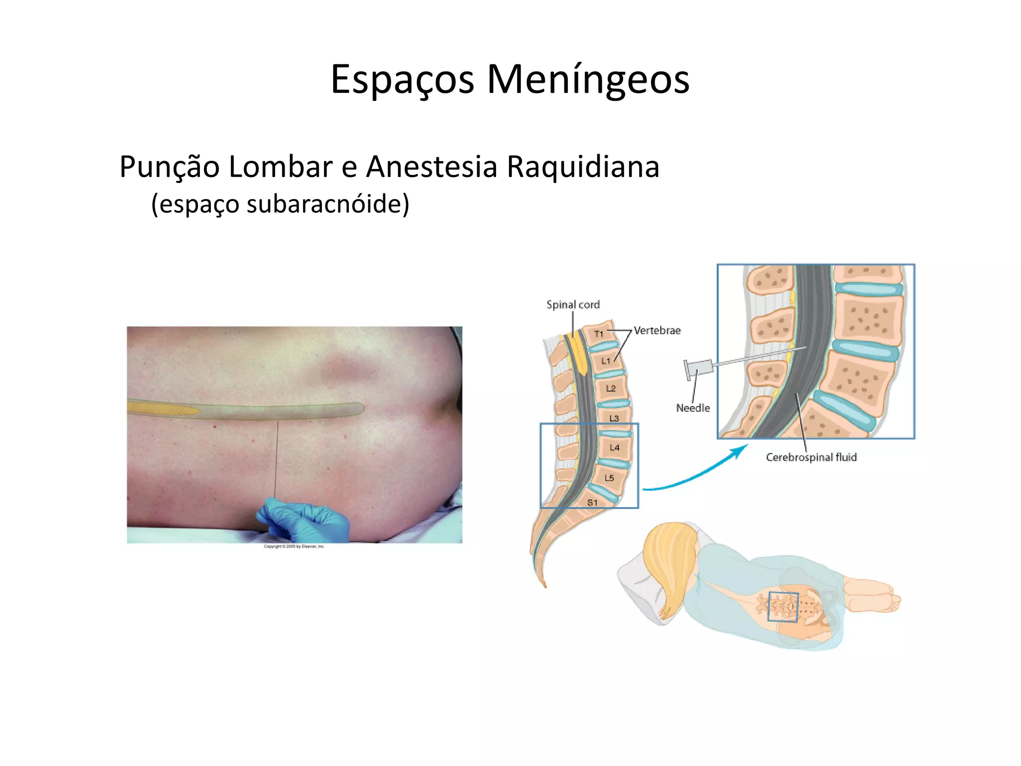 Espaços Meníngeos
Punção Lombar e Anestesia Raquidiana
(espaço subaracnóide)
 