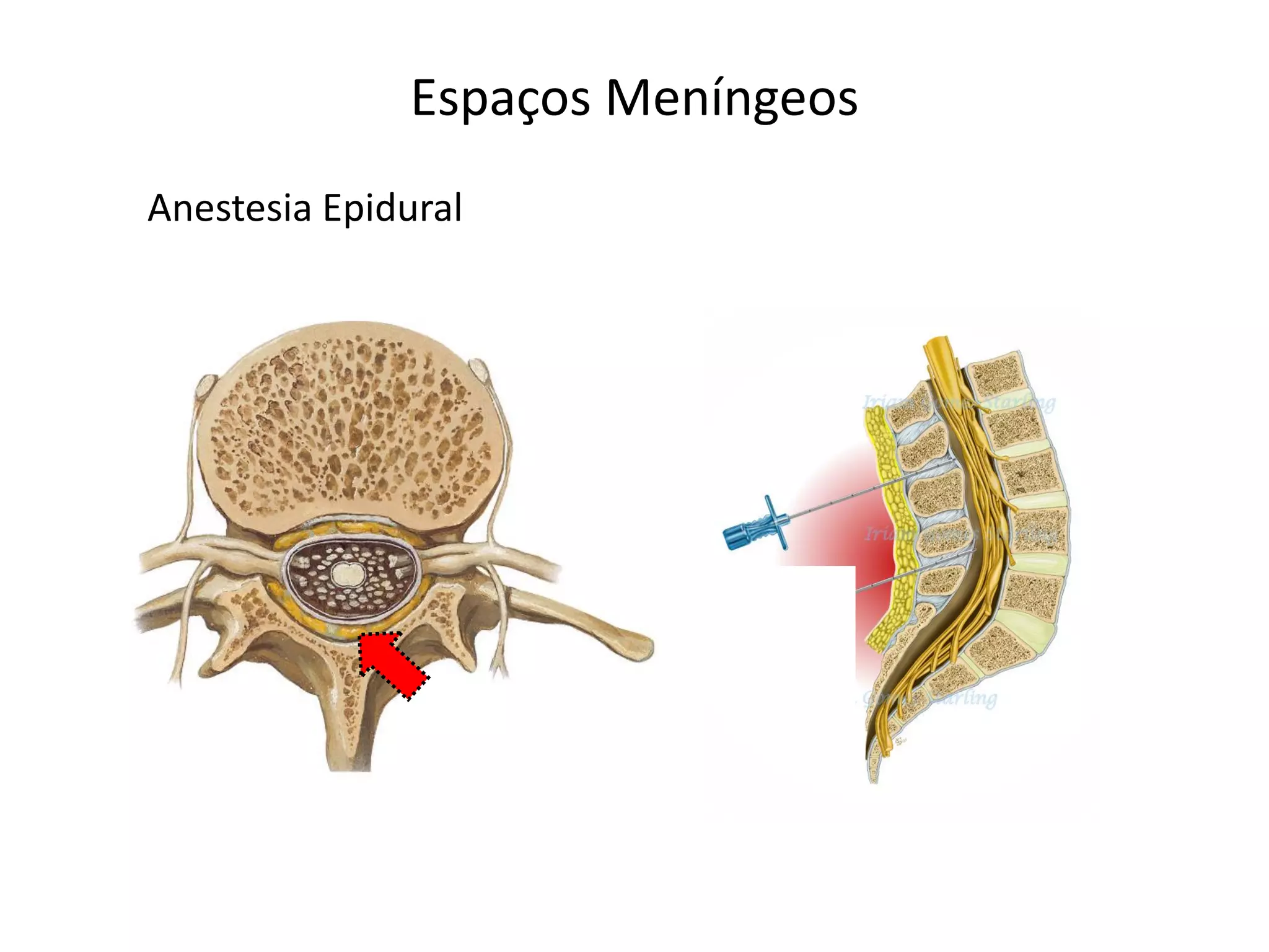 Espaços Meníngeos
Anestesia Epidural
 