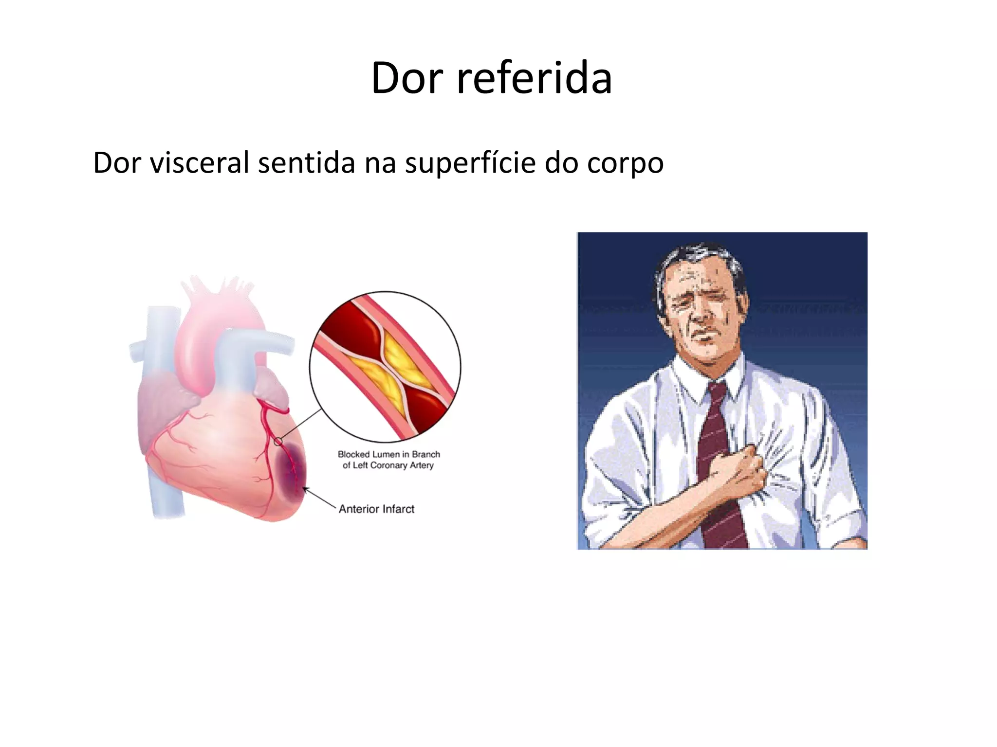 Dor referida
Dor visceral sentida na superfície do corpo
 