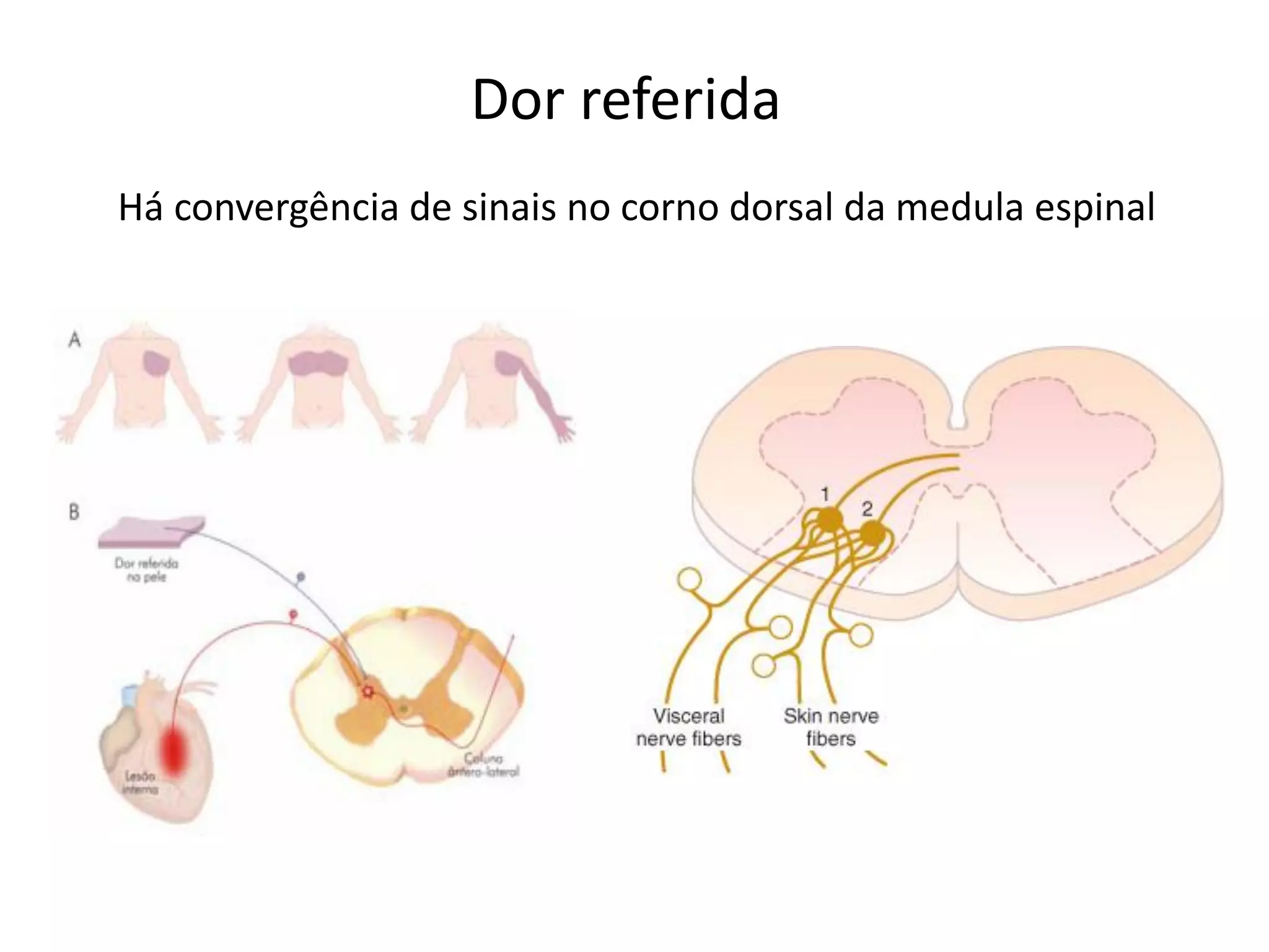 Dor referida
Há convergência de sinais no corno dorsal da medula espinal
 