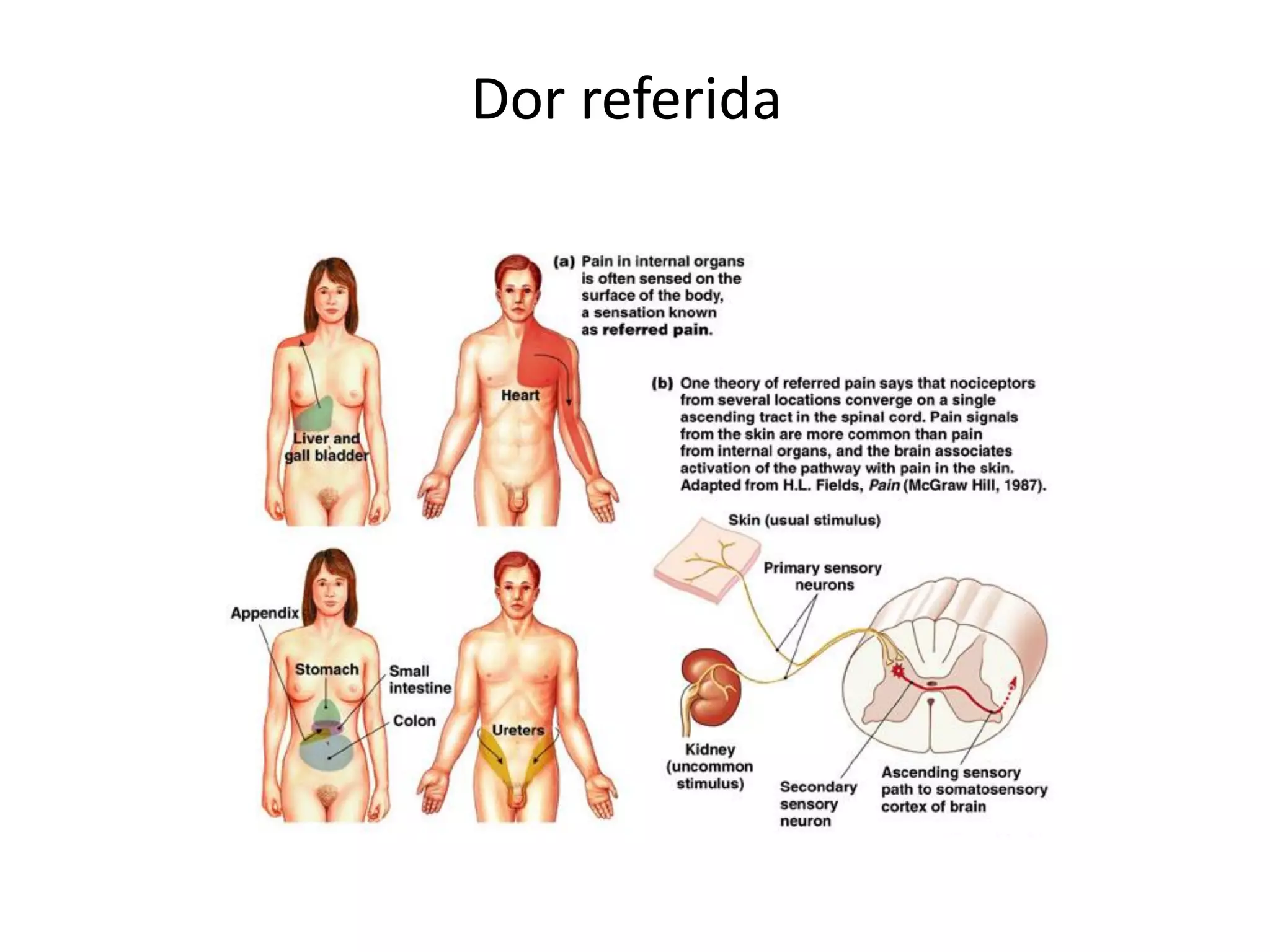 Dor referida
 
