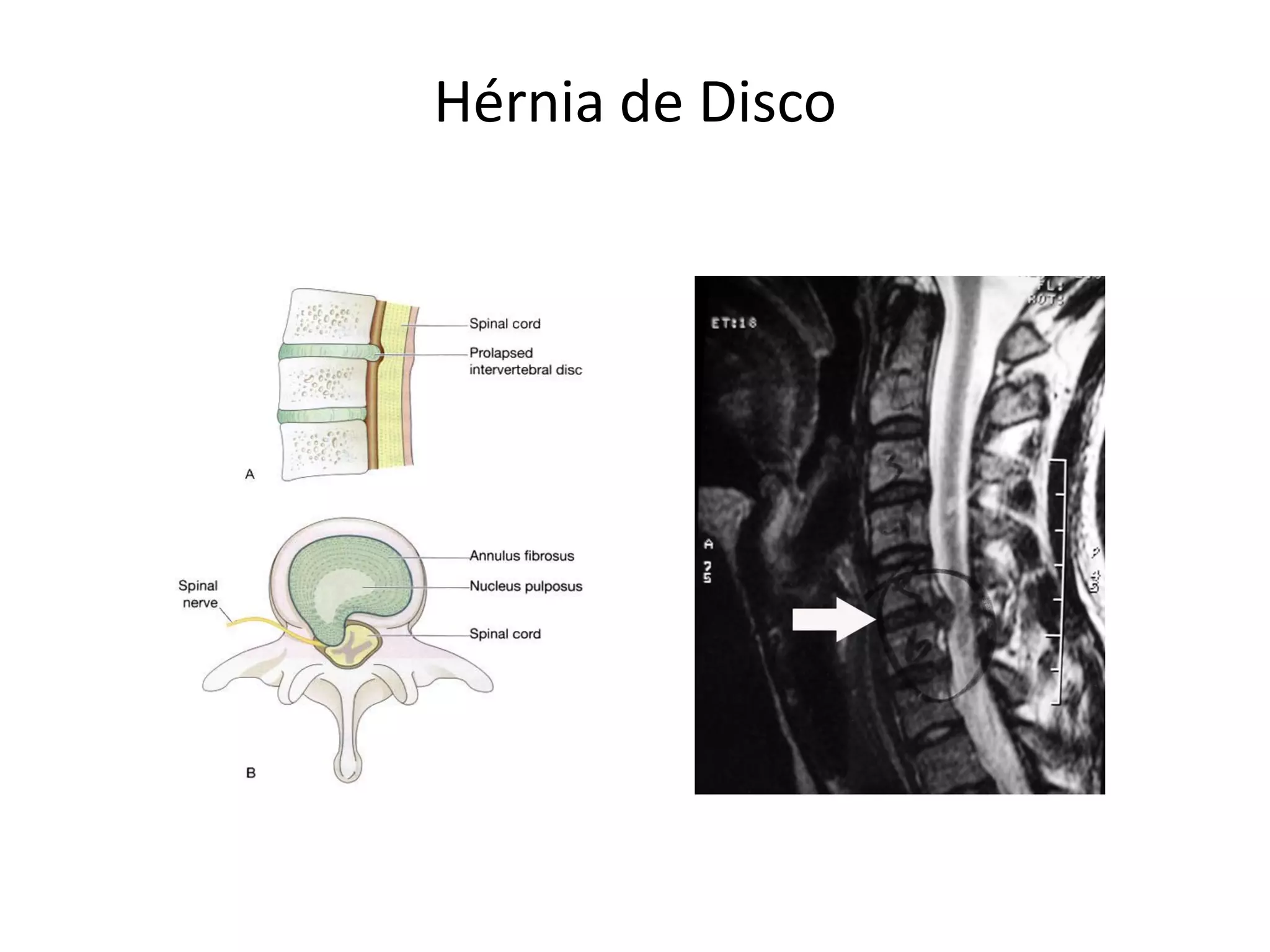 Hérnia de Disco
 