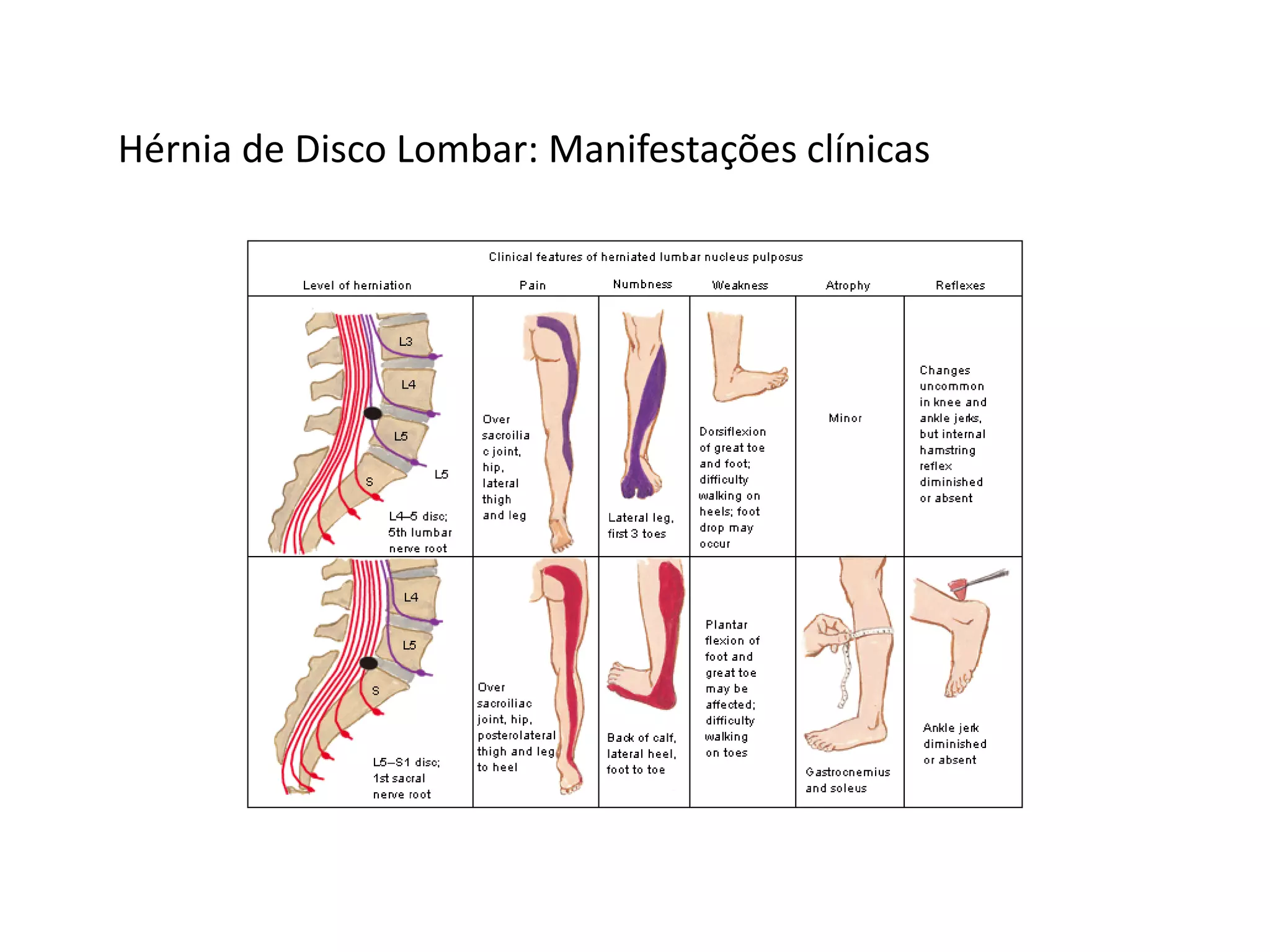 Hérnia de Disco Lombar: Manifestações clínicas
 
