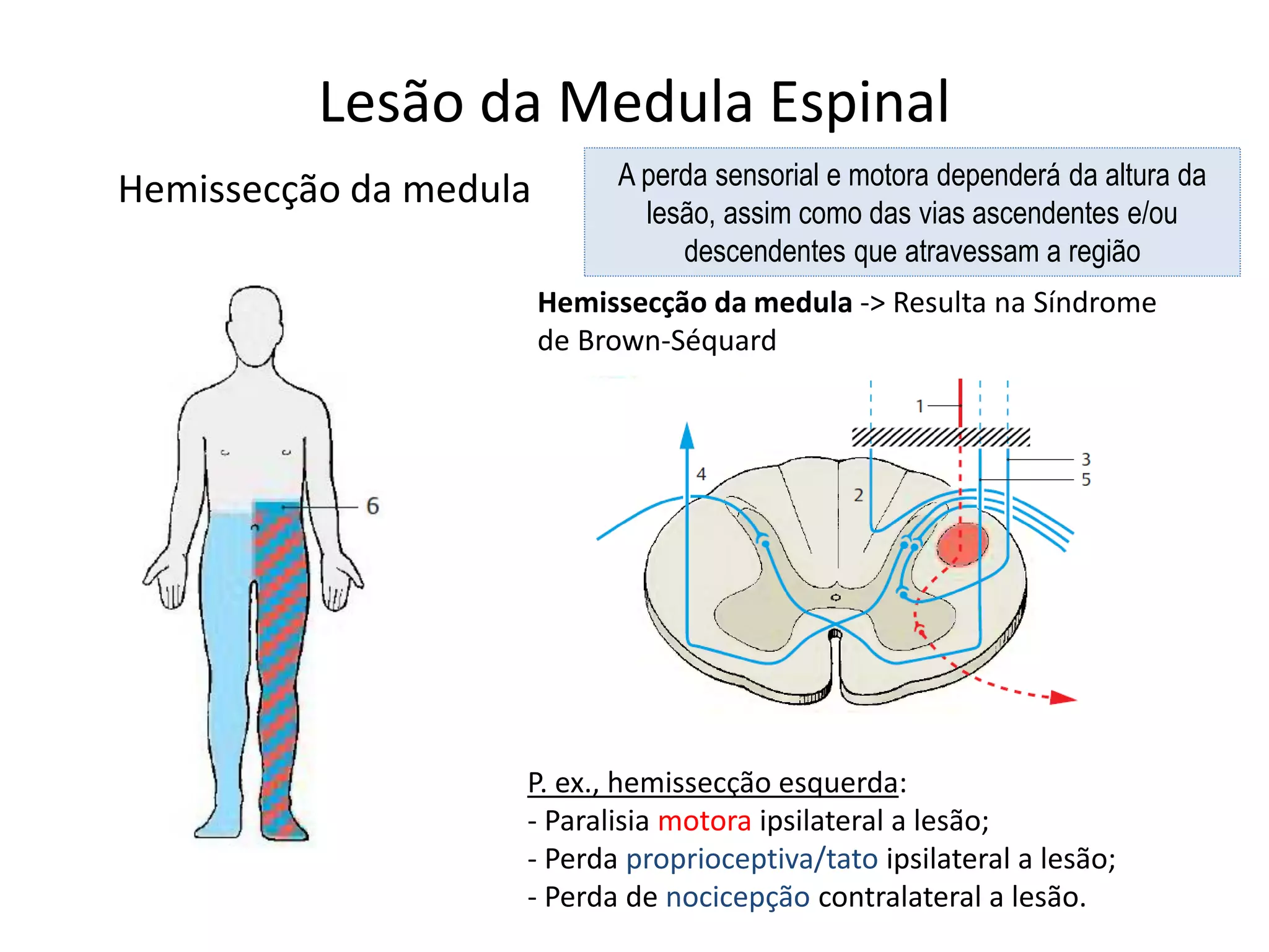 Lesão da Medula Espinal
Hemissecção da medula
Hemissecção da medula -> Resulta na Síndrome
de Brown-Séquard
P. ex., hemissecção esquerda:
- Paralisia motora ipsilateral a lesão;
- Perda proprioceptiva/tato ipsilateral a lesão;
- Perda de nocicepção contralateral a lesão.
A perda sensorial e motora dependerá da altura da
lesão, assim como das vias ascendentes e/ou
descendentes que atravessam a região
 