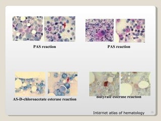 09/14/11 PAS reaction PAS reaction AS-D-chloroacetate esterase reaction Butyrate esterase reaction Internet atlas of hematology 