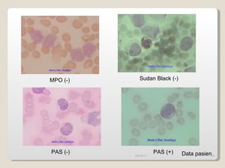 09/14/11 MPO (-) Sudan Black (-) PAS (-) PAS (+) Data pasien 