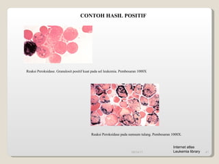 CONTOH HASIL POSITIF Reaksi Peroksidase. Granulosit positif kuat pada sel leukemia. Pembesaran 1000X Reaksi Peroksidase pada sumsum tulang. Pembesaran 1000X. 09/14/11 Internet atlas Leukemia library 