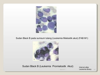 Sudan Black B pada sumsum tulang (Leukemia Mielositik akut) (FAB M1) 09/14/11 Sudan Black B (Leukemia  Promielositk  Akut) Internet atlas Leukemia library 