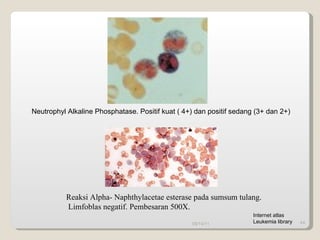 Reaksi Alpha- Naphthylacetae esterase pada sumsum tulang. Limfoblas negatif. Pembesaran 500X.  09/14/11 Neutrophyl Alkaline Phosphatase. Positif kuat ( 4+) dan positif sedang (3+ dan 2+) Internet atlas Leukemia library 